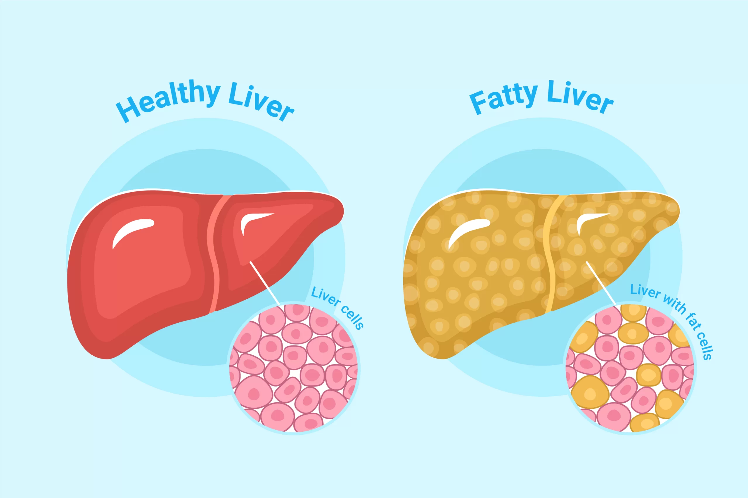 Battling Fatty Liver: Simple Exercises to Boost Liver Health