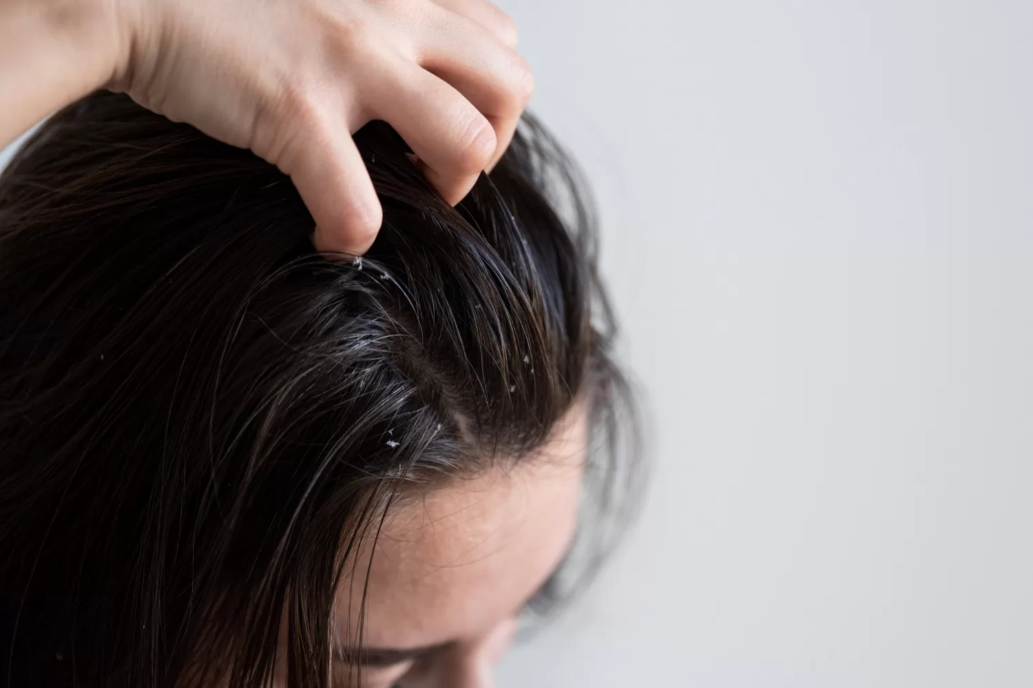 Say Goodbye to Dandruff: Unveiling the Roots and Home Remedies for a Healthy Scalp